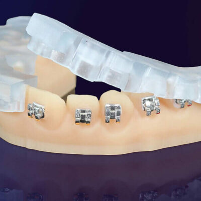 KeyOrtho-IBT-Dental-Material-e1715765474720