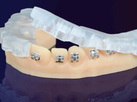 KeyOrtho-IBT-Dental-Material-e1715765474720